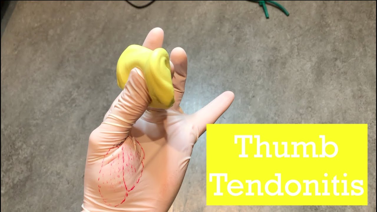 How to Fix Thumb Tendonitis