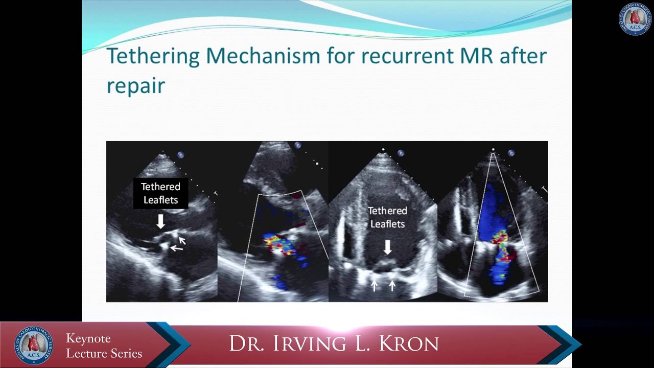 [Keynote lecture] Repair or replace for severe ischemic mitral regurgitation