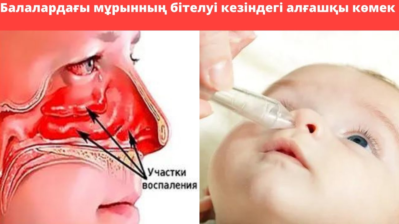 Балалардағы мұрын бітелу кезіндегі алғашқы көмек