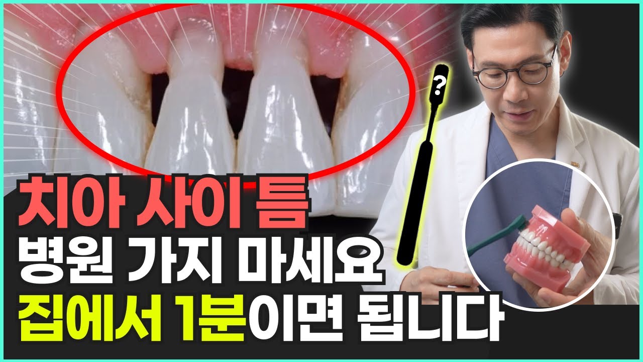 벌어진 앞니, 치아 사이 틈 해결하는 방법 | 블랙트라이앵글 예방, 치료법