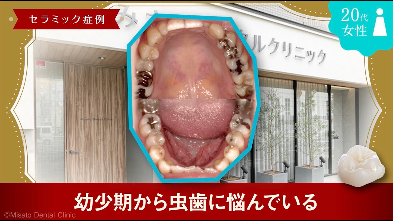 ［動画版］「幼少期から虫歯に悩んでいる」セラミック症例