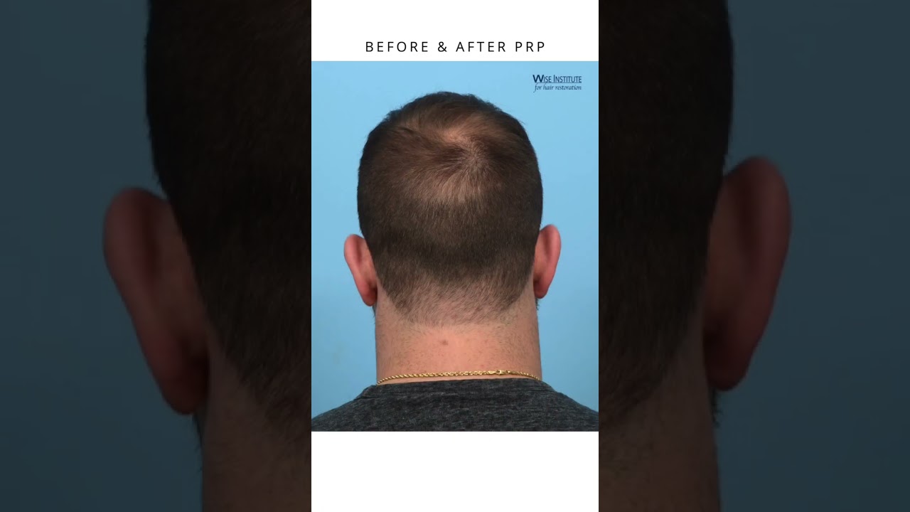 Before & After 3 sessions of PRP Therapy