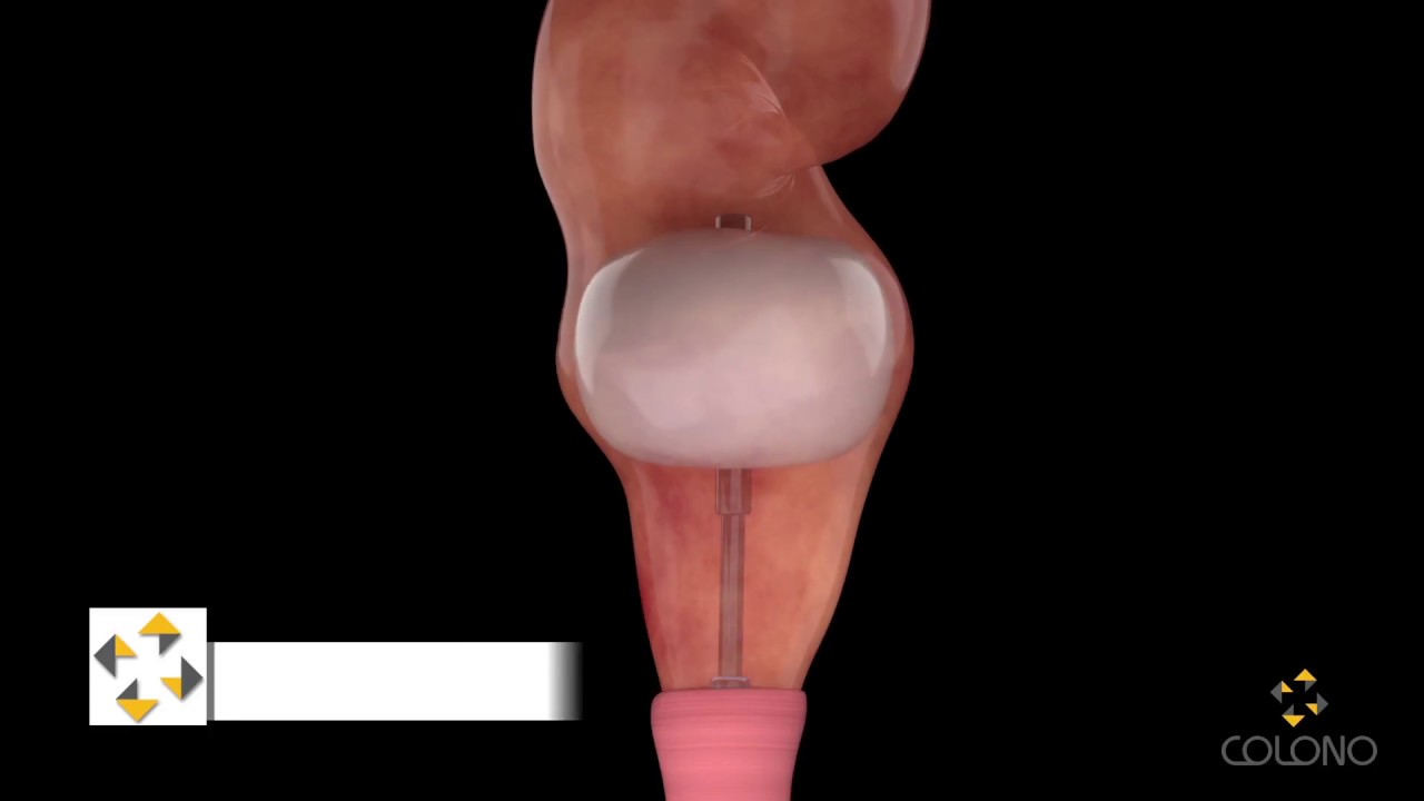 Eletromanometria Anorretal - COLONO, Clínica do Aparelho Digestivo.
