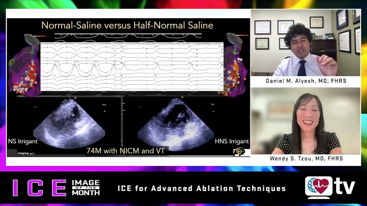 ICE Image of the Month: ICE for Advanced Ablation Techniques