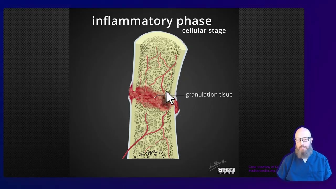 Bone Fracture Healing and Types of Fracture