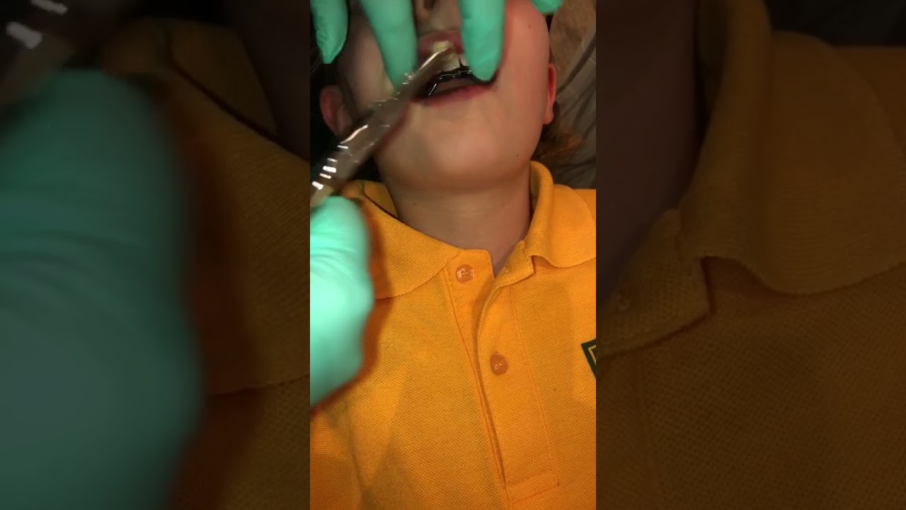 How to remove RME/Maxillary Expander