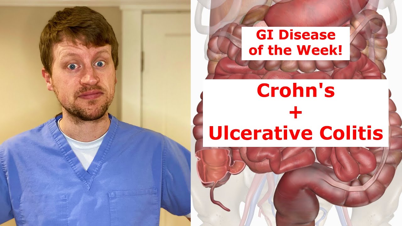 Inflammatory Bowel Disease (Crohn&rsquo;s and Ulcerative Colitis) in 90 Seconds