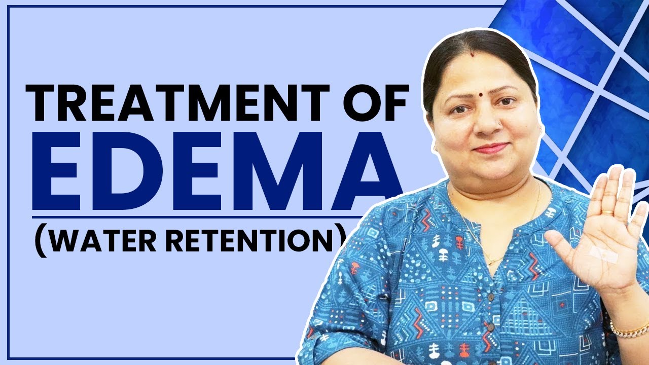Treatment of Edema (Water Retention) || सूजन (एडिमा) का इलाज by Acupressure