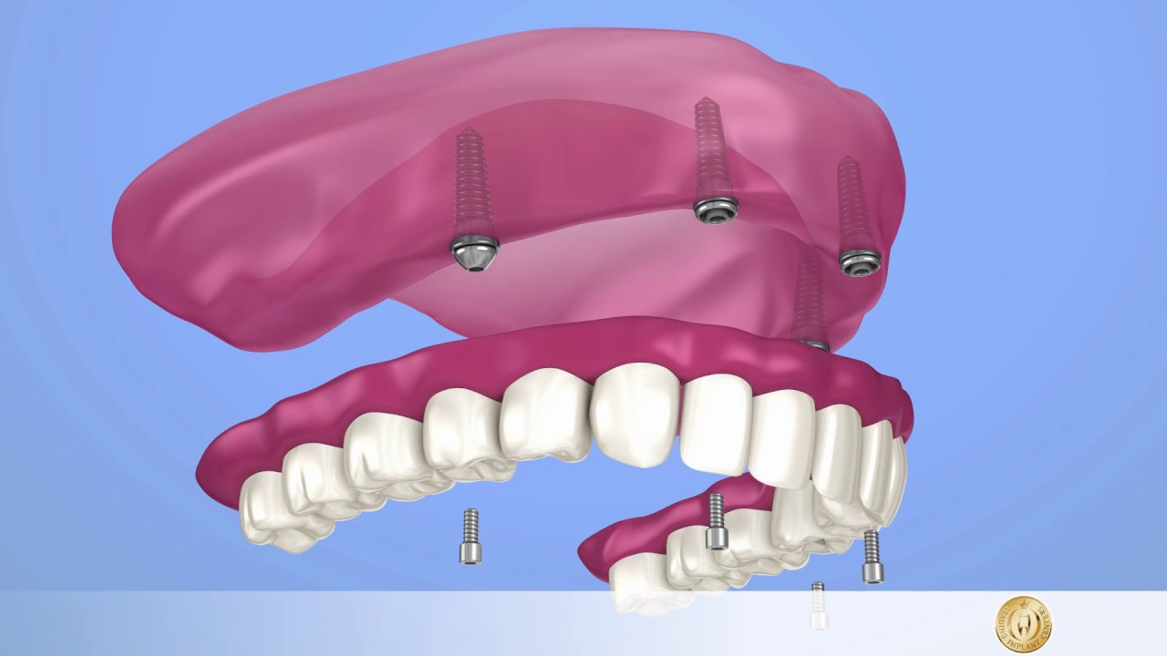 Implantologie: Fester Zahnersatz mit All-On-4-Implantat im Oberkiefer