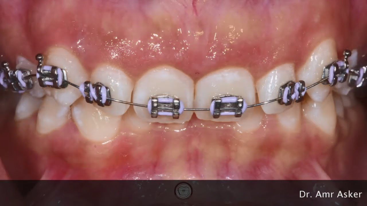 Braces time-lapse , Deep Bite progress