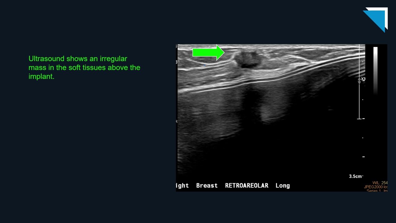 Breast Imaging Challenging Cases | Free Radiology CME