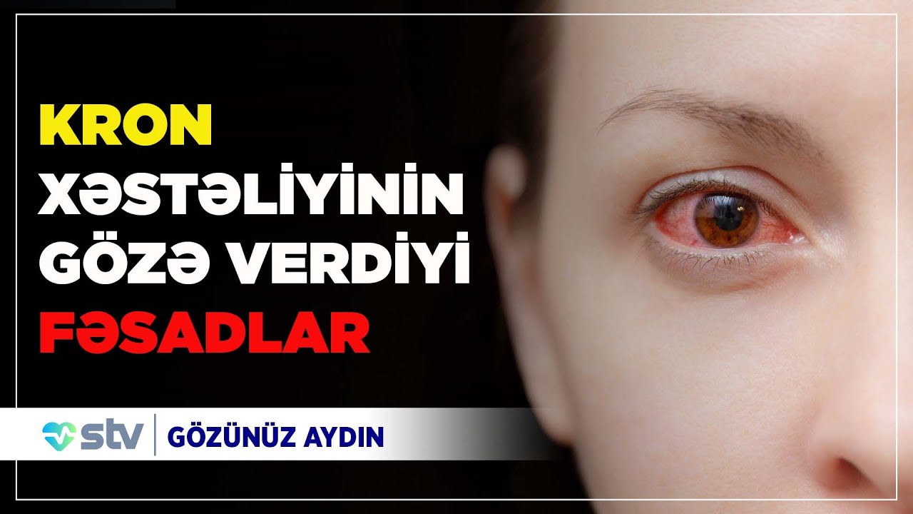 KRON xəstəliyi və GÖZ (02.05.2021)