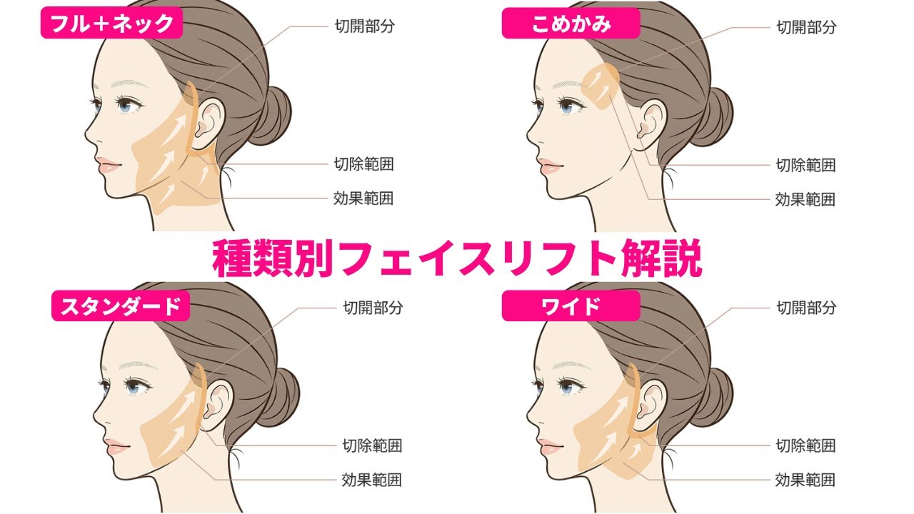 フェイスリフトの種類で効果はどう違うのか！？