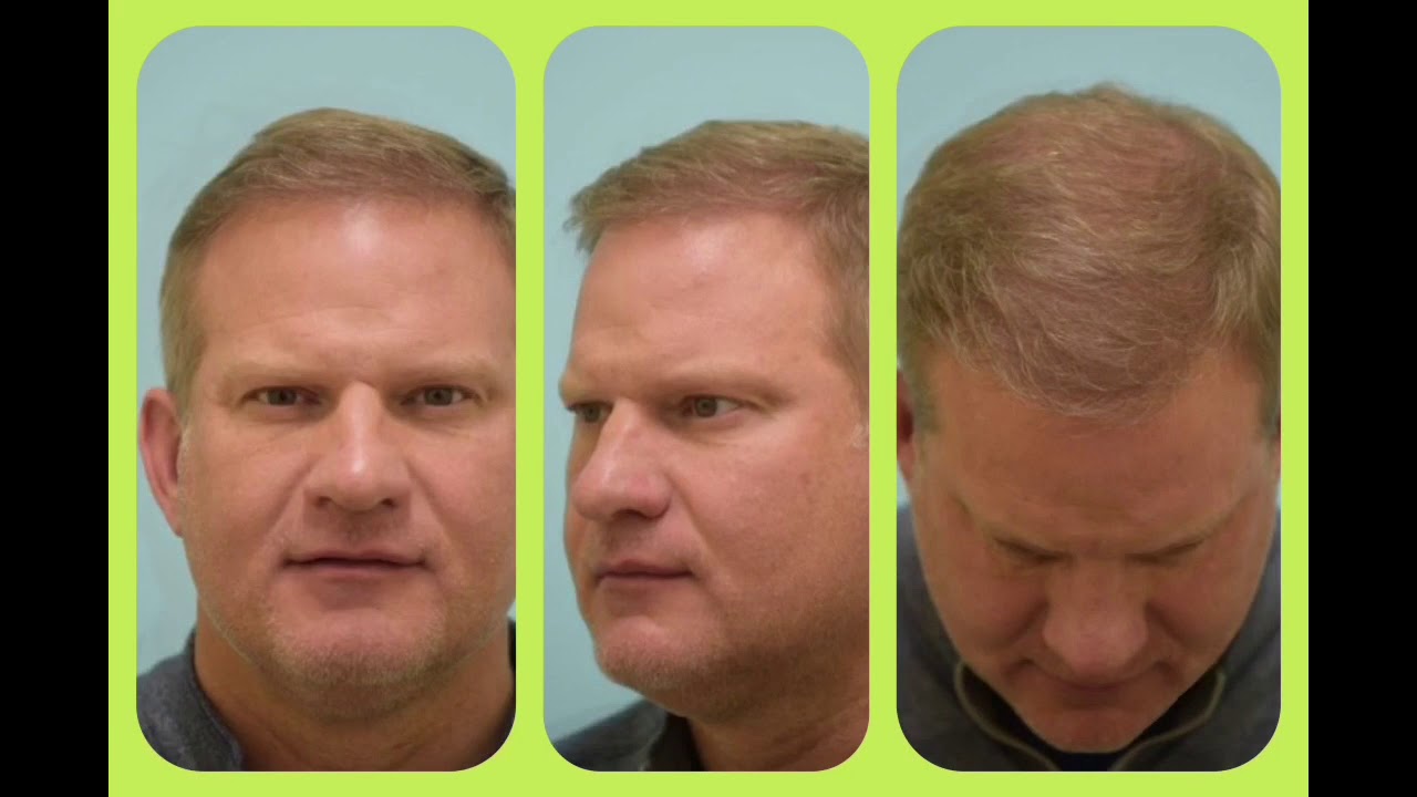 Dallas Megasession Hair Transplant Video Transformation