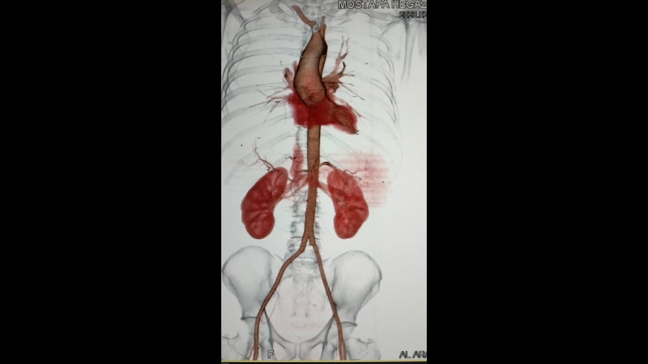 فحص الاشعه المقطعيه علي الشريان الاورطي بالصبغه /CT angiography of aorta part 2