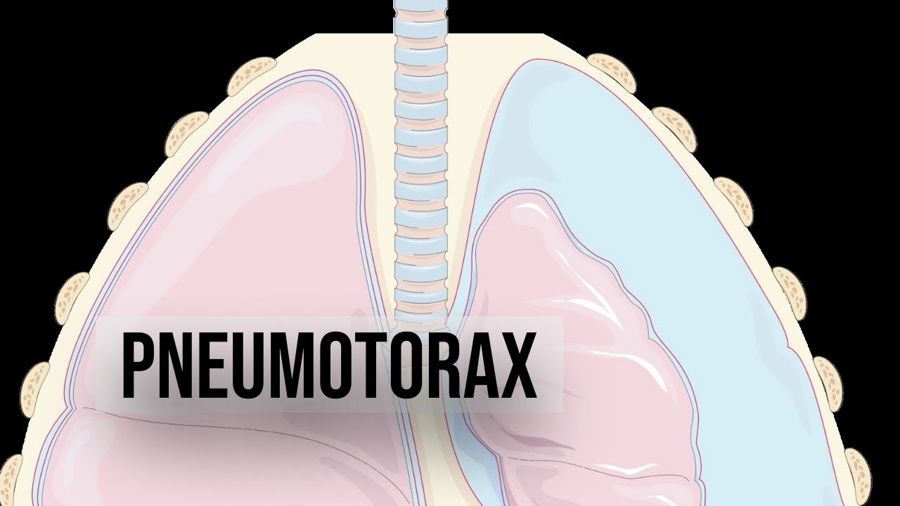 Ce înseamnă pneumotorax?