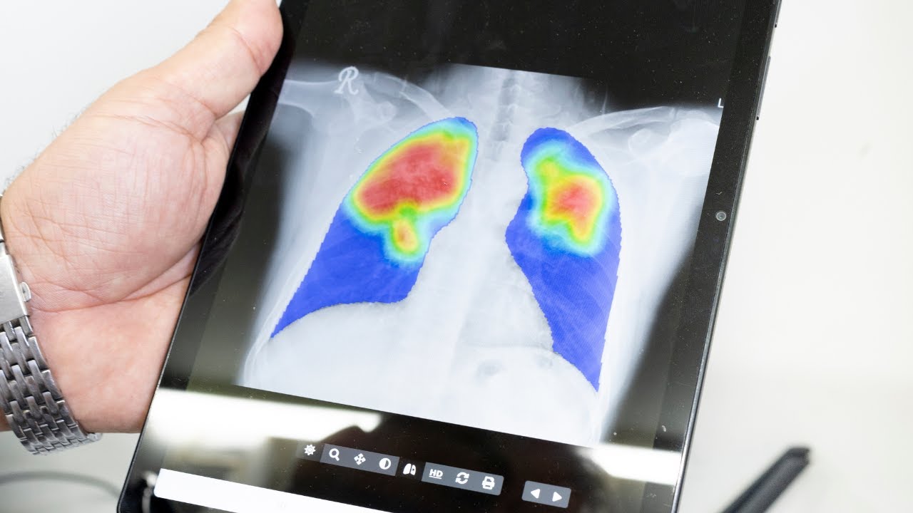 The Iraqi Ministry of Health has adopted CAD4TB to enhance early detection of TB nationwide.