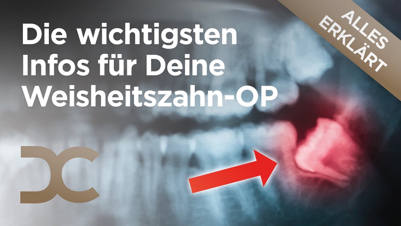 Weisheitszähne entfernen: Alles zur schonenden Weisheitszahn-OP in Dämmerschlaf | Dorow Clinic