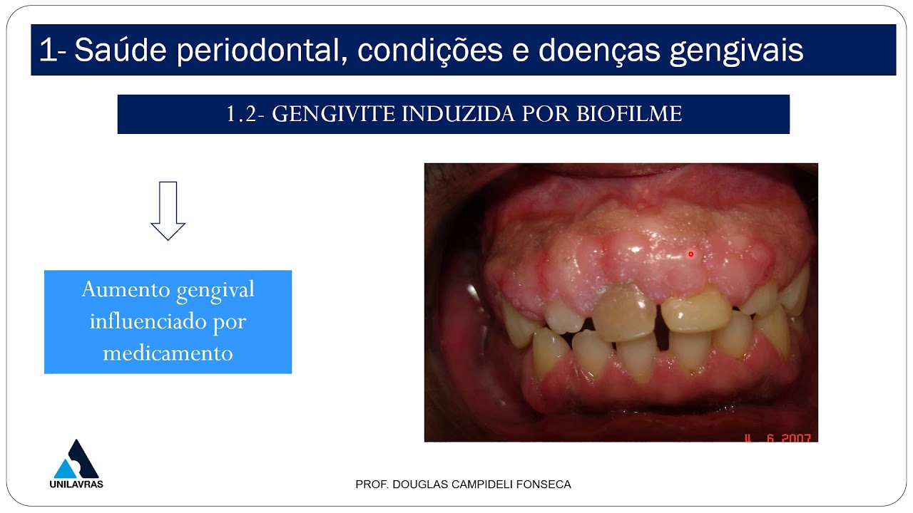 Classificação das doenças periodontais 2017 - Gengivite