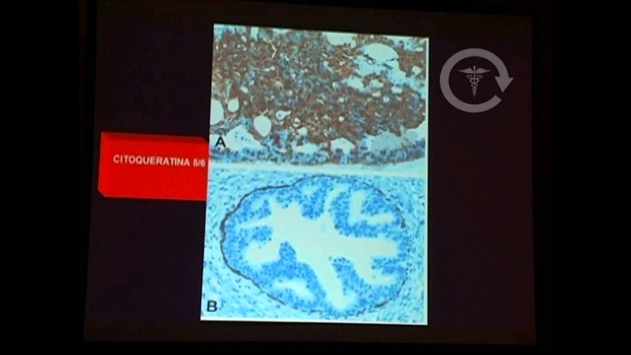 Marcadores de Inmunohistoquímica para el Cáncer de Mama