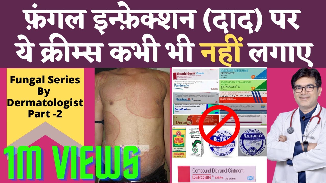 Ringworm Fungal Infection Treatment In Hindi | Fungal Infection Cream Without Steroids | Dr Sunil
