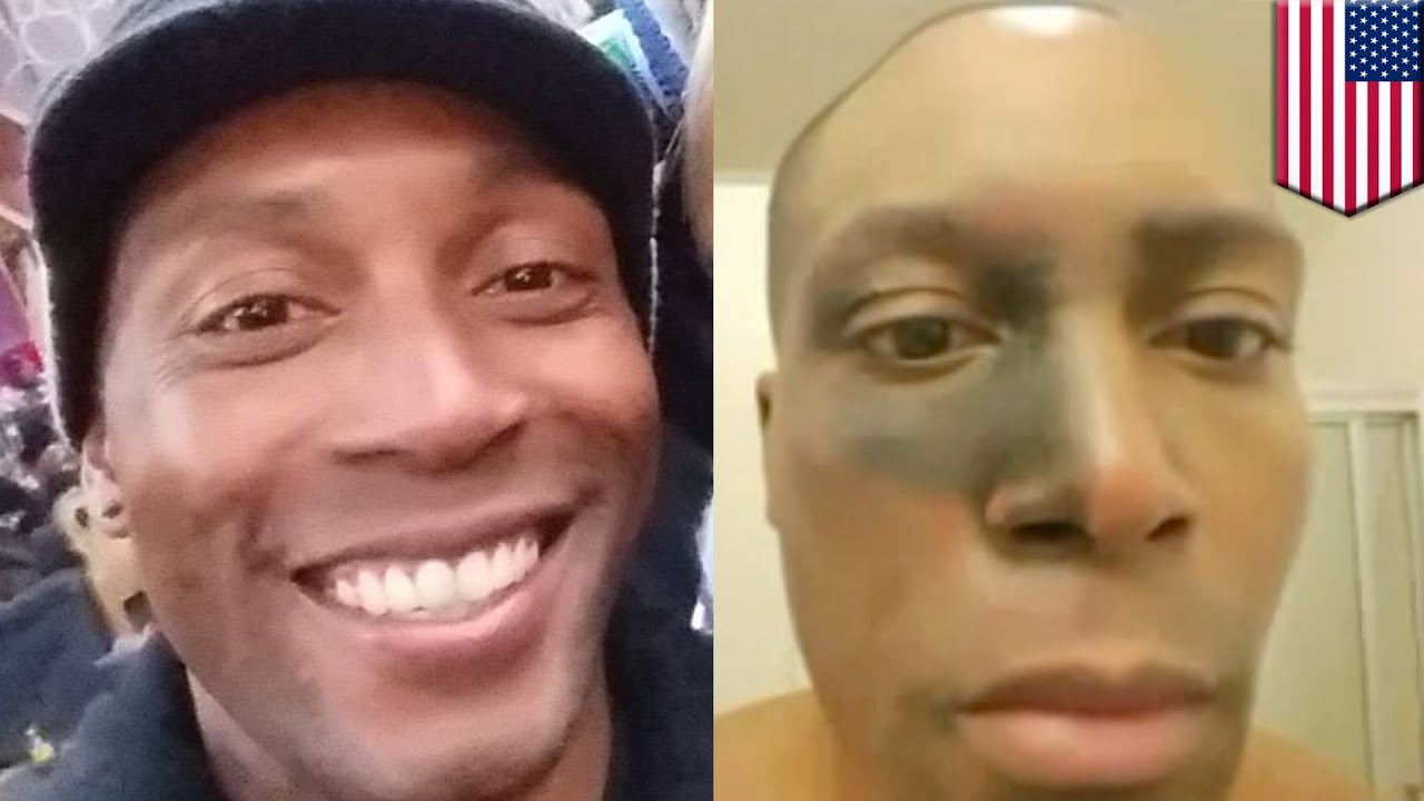 E-cig explosion: Vape pen burns and and permanently scars Air Force veteran - TomoNews