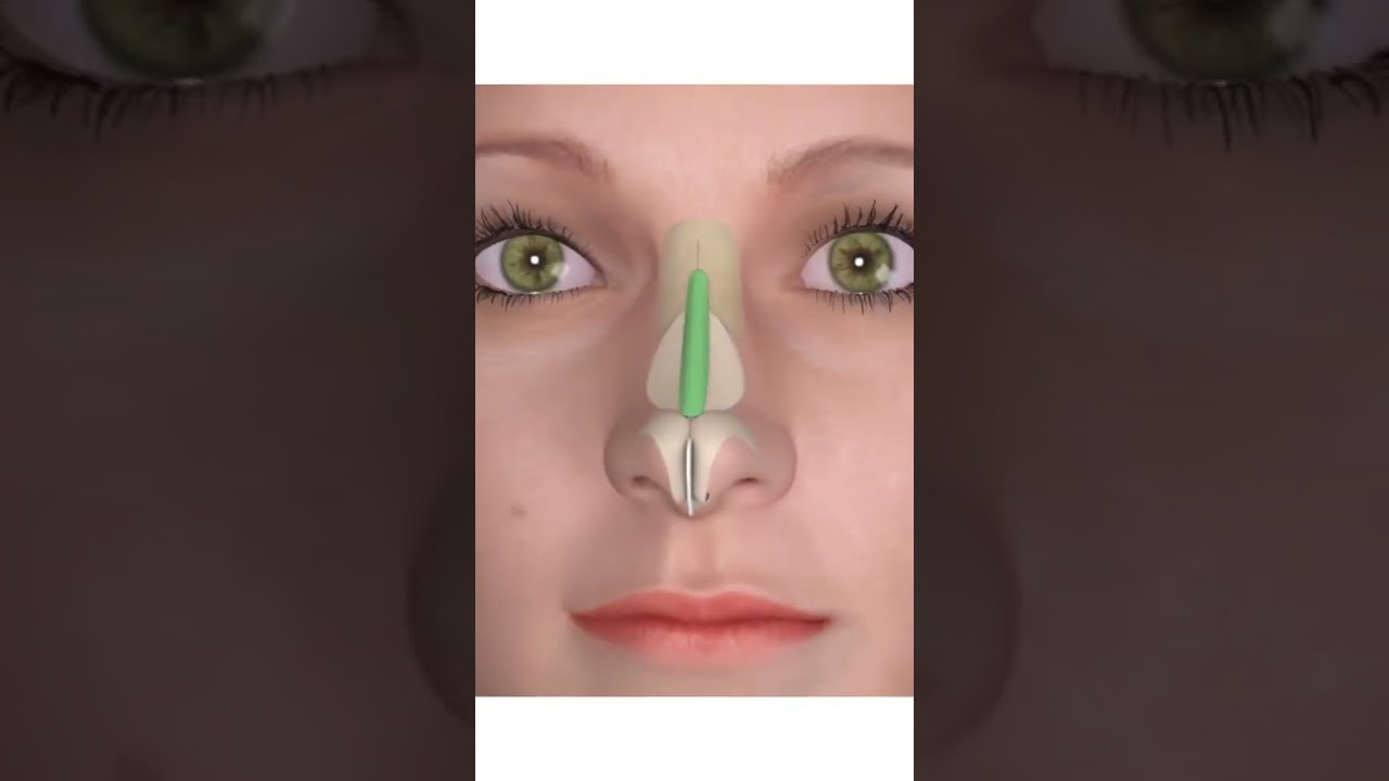 Rhinoplasty steps