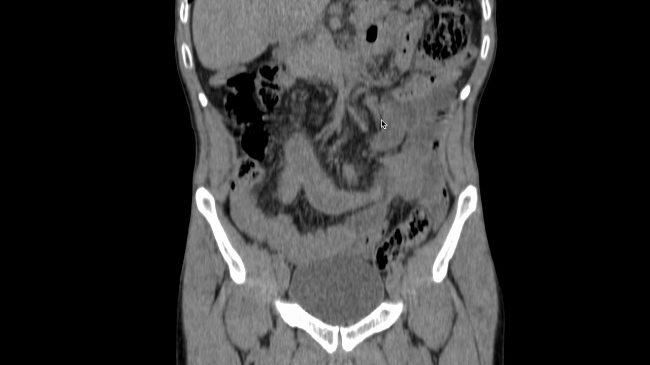 Ileo-ileal intussusception due to ileal lipoma and resultant mesenteric volvulus