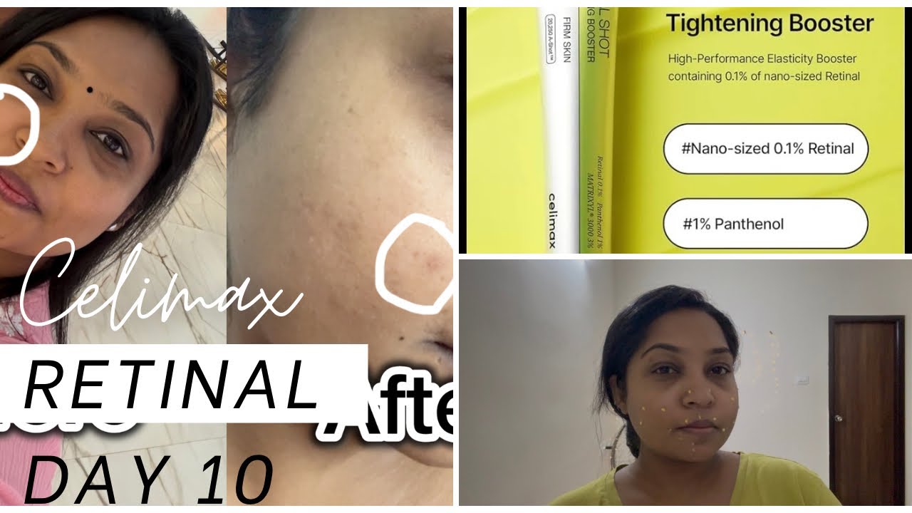 Day - 10 | Final day - vlog # 24| Celimax retinal shot review 