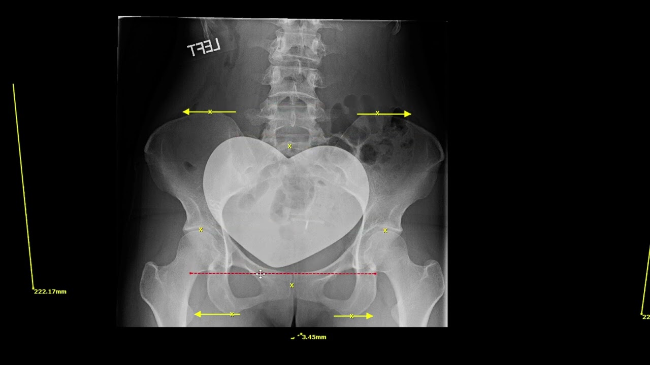 Gonstead Pelvis Analysis - PI/AS and IN/EX