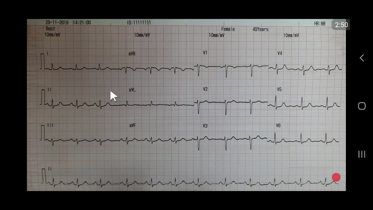 ECG 15 R thấp ở V1, V2, V3 là sinh lý hay bệnh lý