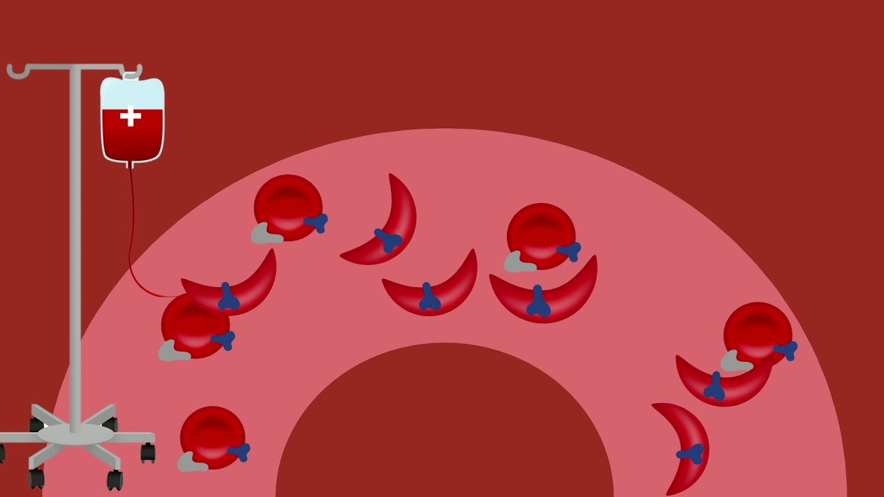 Episode 3:  Transfusion reactions