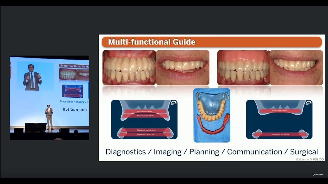 Immediate full arch restoration using the Straumann&reg; Pro Arch treatment approach