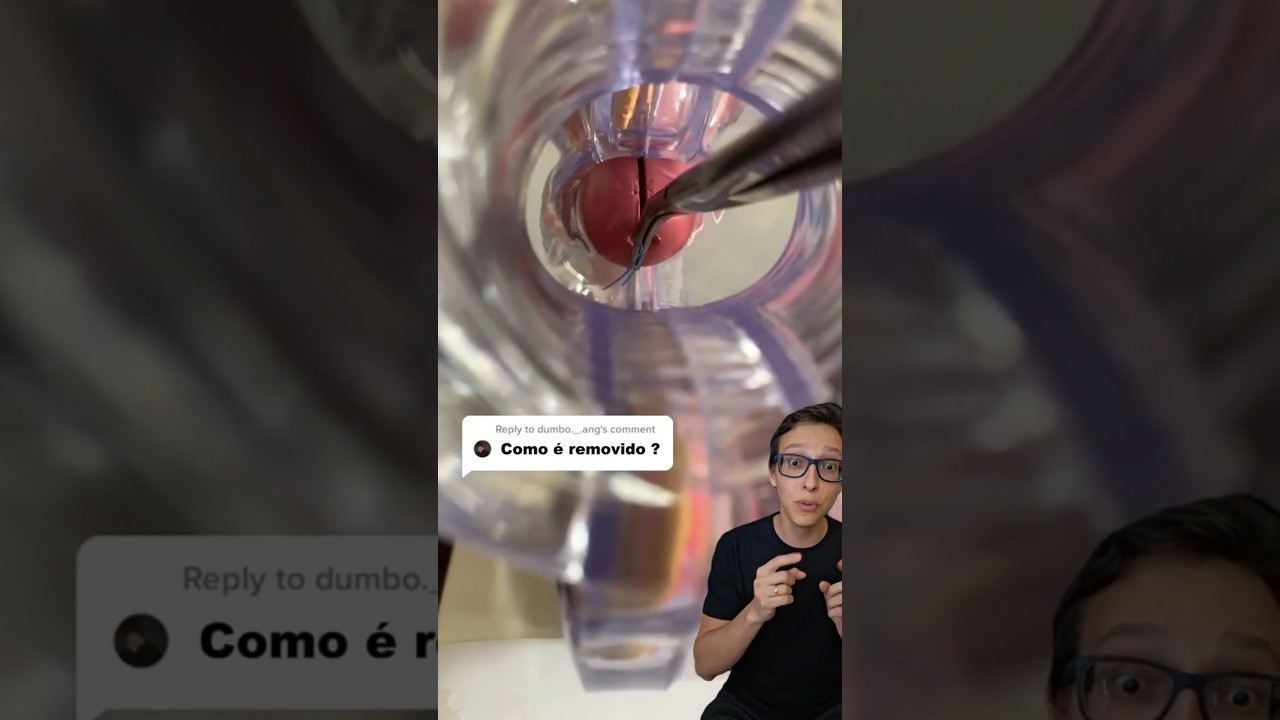 Coloca&ccedil;&atilde;o de DIU 😱#medicina #medico #enfermagem #ginecologia #ginecologista #anticoncepcional Mirena