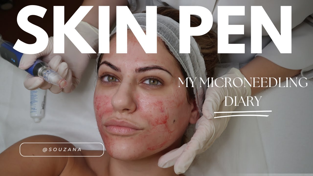 ΠΡΙΝ & ΜΕΤΑ: SkinPen Microneedling 💁🏻‍♀️
