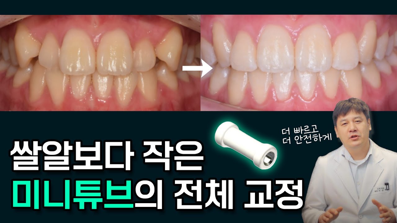 앞니만 하려다 전체 교정까지! 티 안 나고 빠른 '미니튜브' 교정의 모든 것