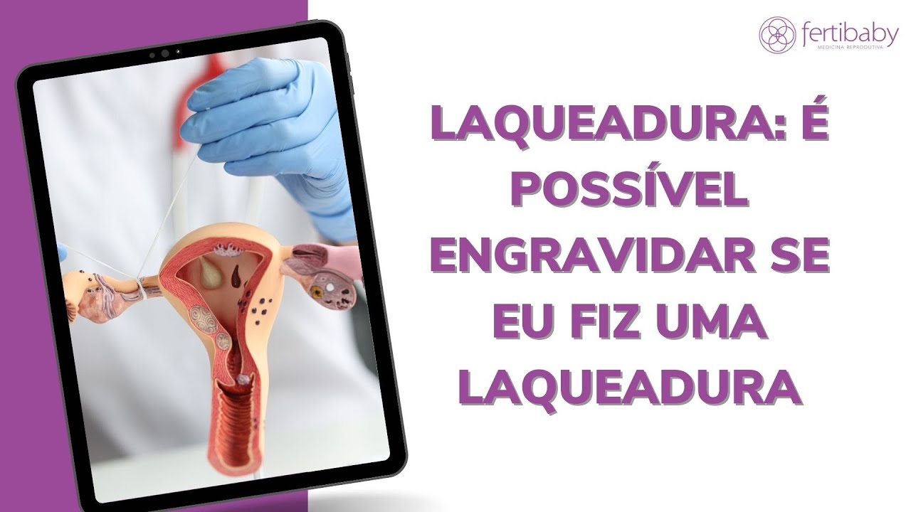 LAQUEADURA: É POSSÍVEL ENGRAVIDAR SE EU FIZ UMA LAQUEADURA
