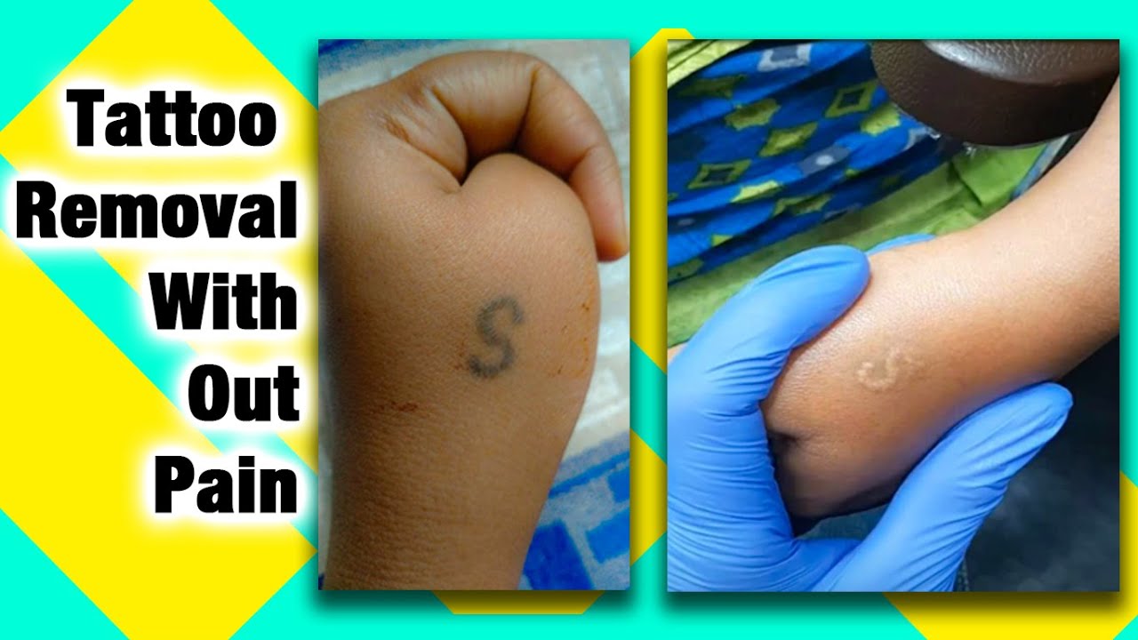 Tattoo Removal | Best Tattoo removal In Bangalore | Vedic Trend Tattoos