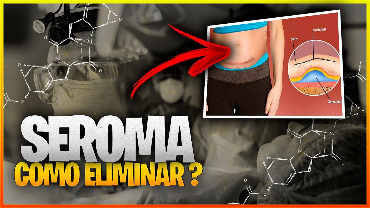 Aprendi a Lidar com o SEROMA em 30 Dias e Você Também Pode!