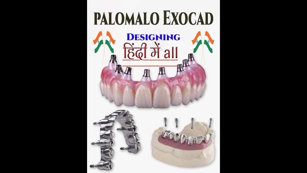 Dramatically Simplify Your Screw Retained Crown & Bridge Work with Exocad & Palomalo!