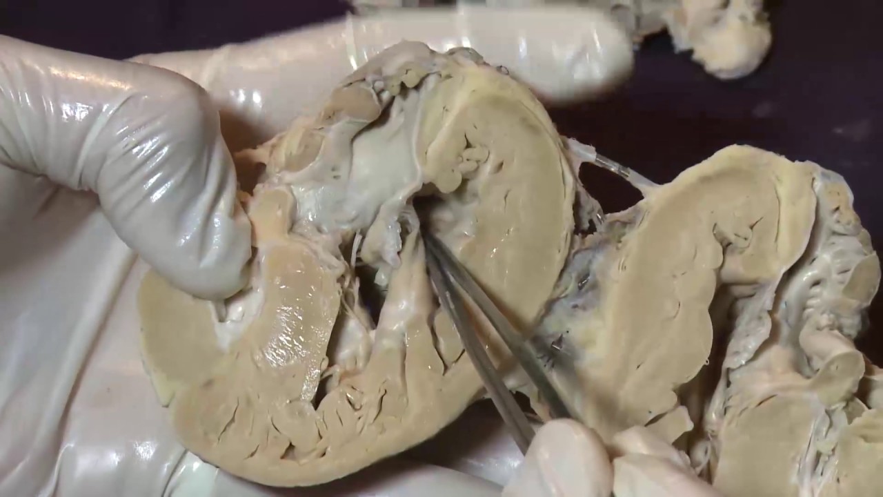 Functional single ventricle with staged fontan operation (Live demonstration)