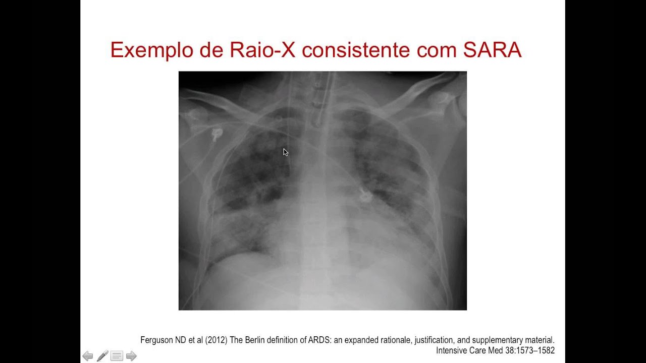 A nova definição de SARA e a fisiopatologia