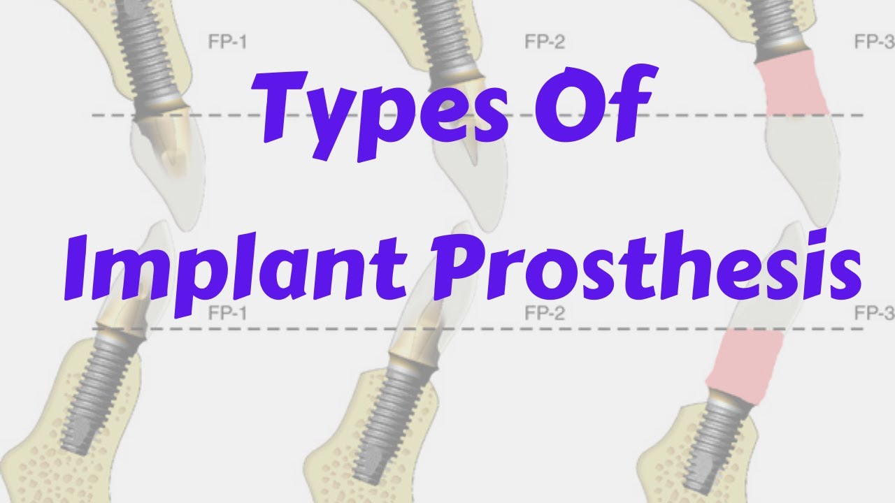 Classification Implant Supported Prosthesis- Fixed, Removable, Full arch || Implant Lecture Course