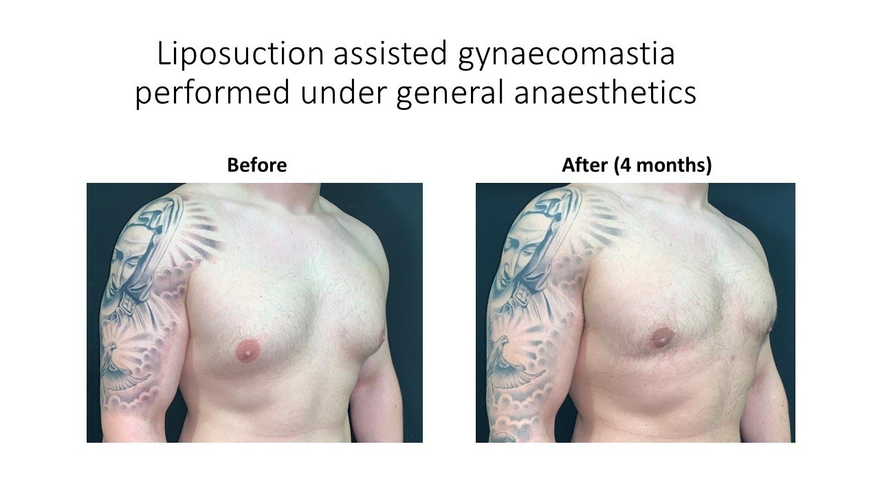 Liposuction assisted excision (removal) of bilateral gynecomastia under general anaesthetics