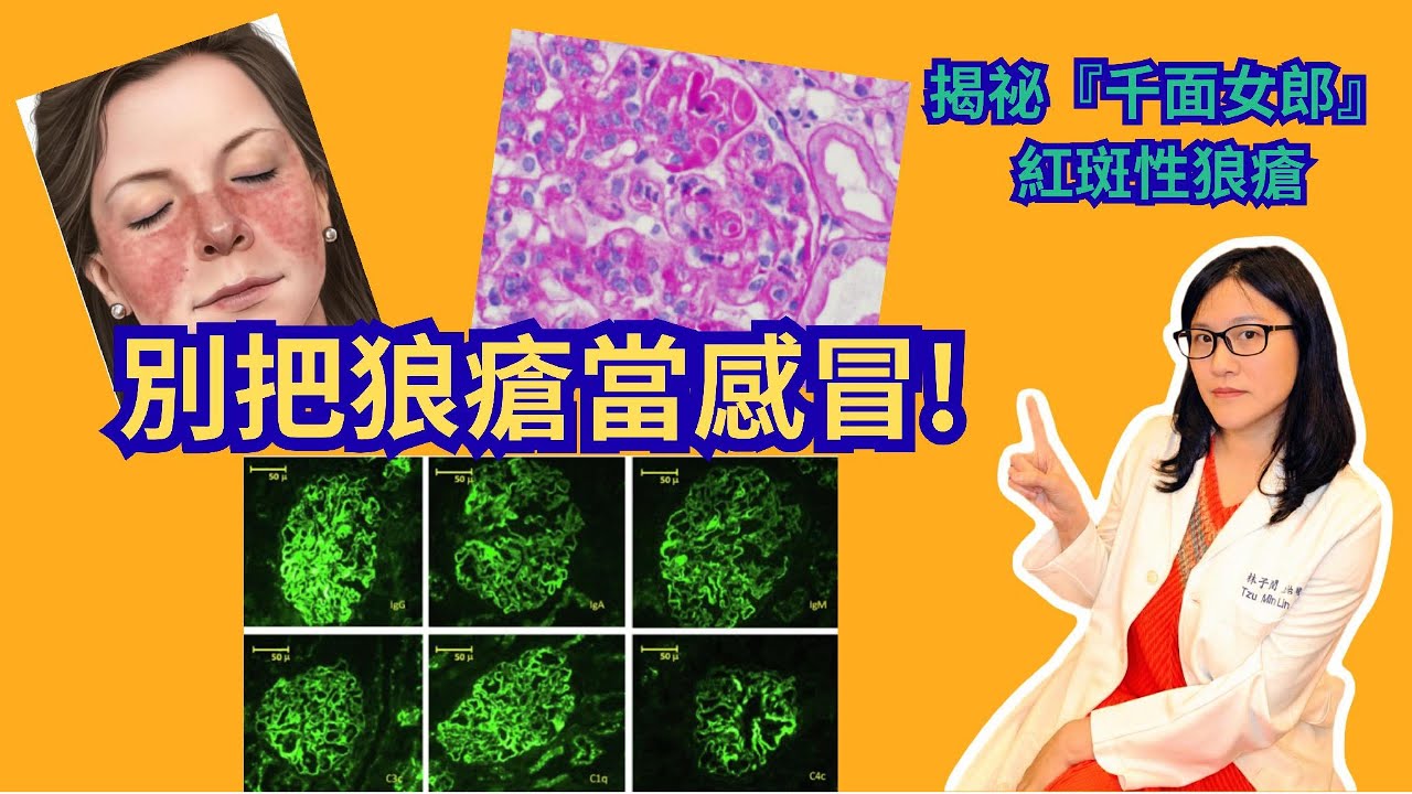 從蕁麻疹到腎衰竭？揭祕「千面女郎」紅斑性狼瘡：這類女性最危險！別把免疫大軍叛變當感冒！