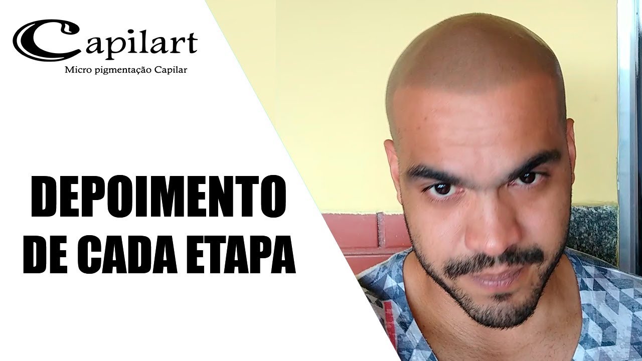 DEPOIMENTO de CADA ETAPA - Micropigmentação capilar | Capilart