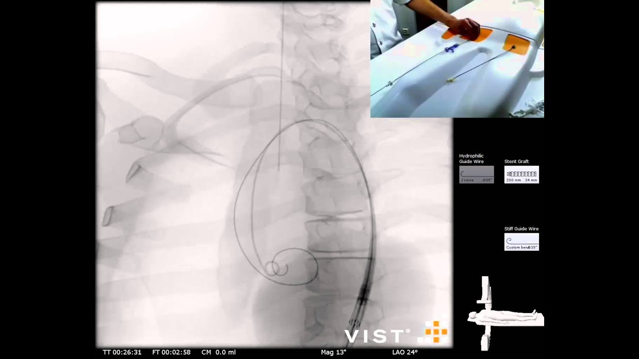 Mentice - Thoracic Endovascular Aortic Repair (TEVAR) Case Video