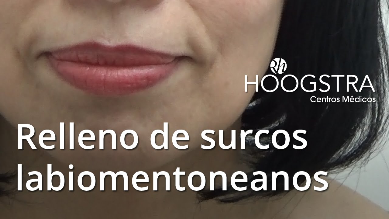 Relleno de surcos labiomentoneanos con ácido hialurónico (15033)