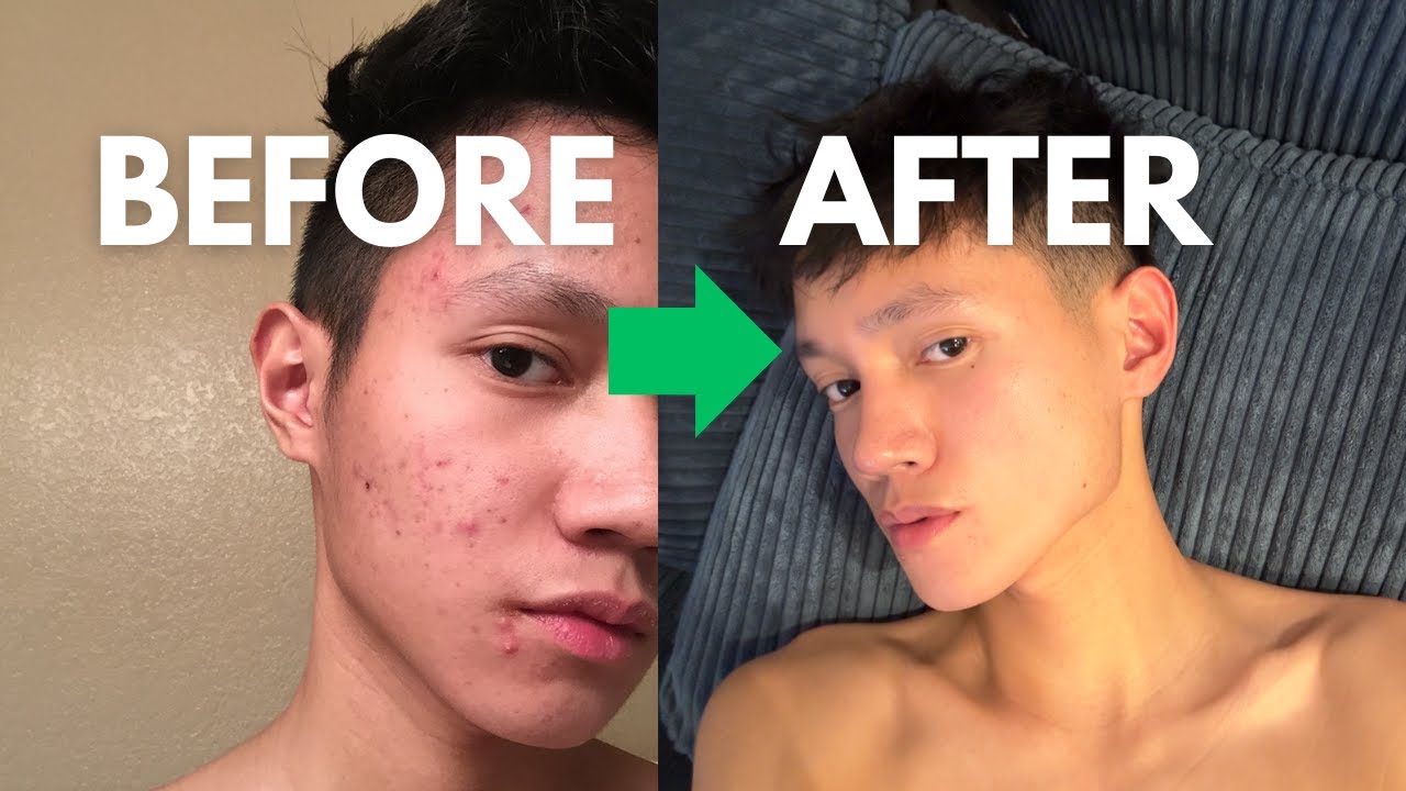 How I Got Rid of My Acne With ONE PRODUCT