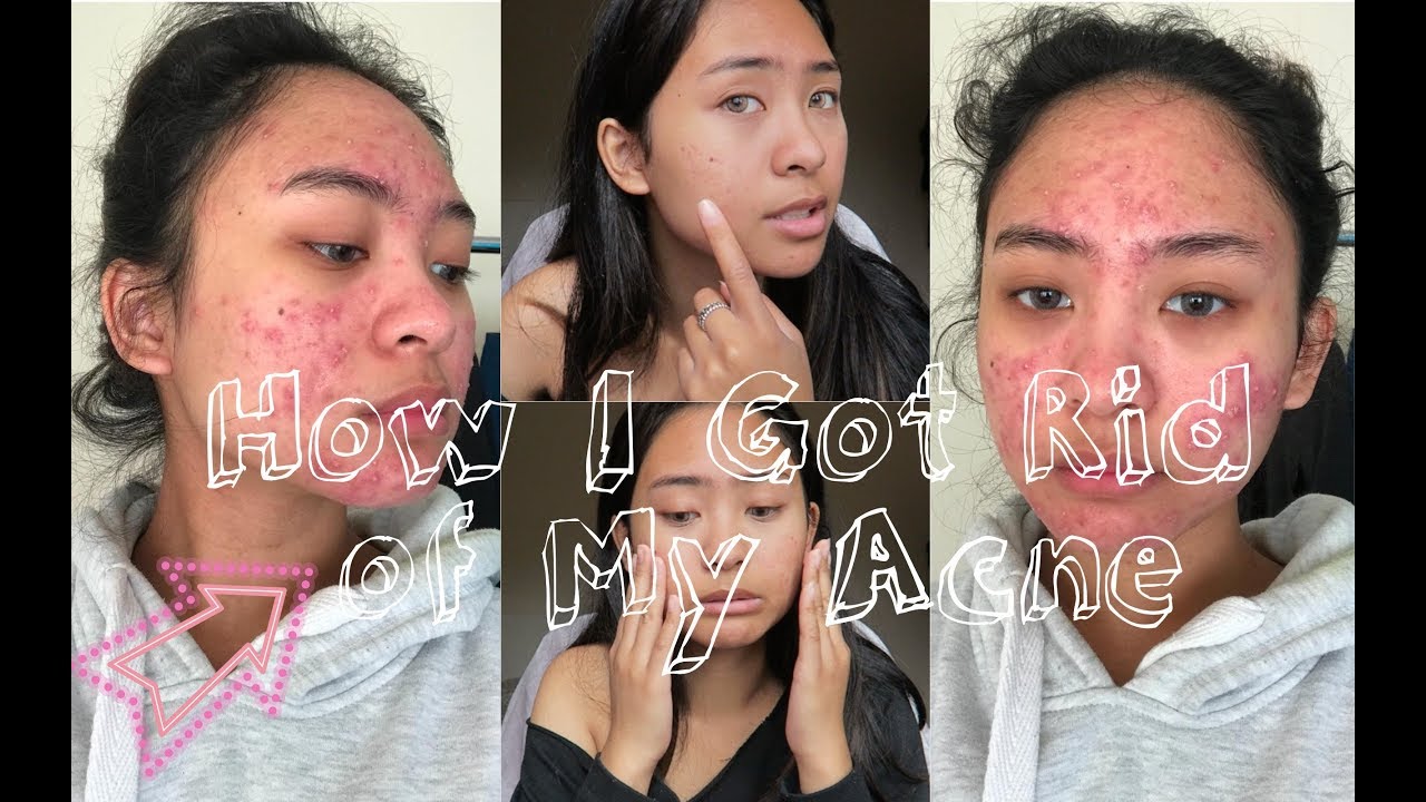 Girl Talk with Sarahlaineee: How I got rid of my acne fast! // My acne.org journey